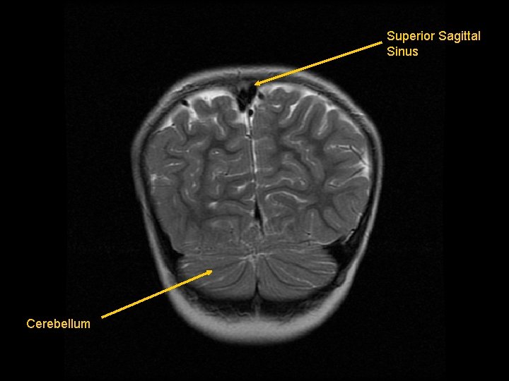 Superior Sagittal Sinus Cerebellum 