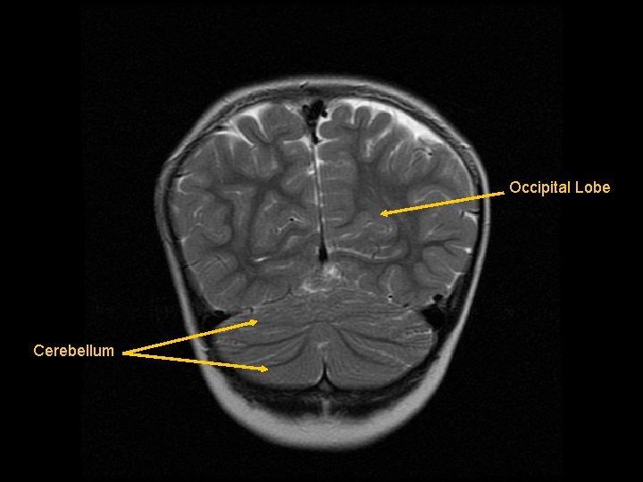 Occipital Lobe Cerebellum 