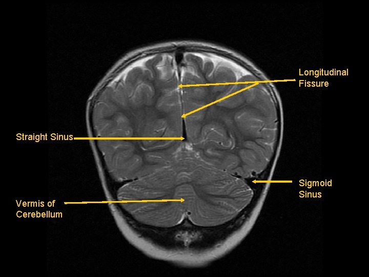 Longitudinal Fissure Straight Sinus Vermis of Cerebellum Sigmoid Sinus 