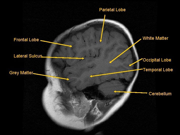 Parietal Lobe Frontal Lobe Lateral Sulcus Grey Matter White Matter Occipital Lobe Temporal Lobe