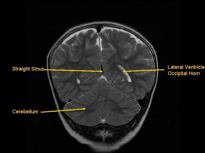 Straight Sinus Cerebellum Lateral Ventricle, Occipital Horn 