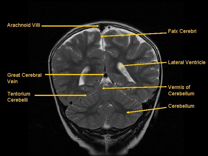 Arachnoid Villi Falx Cerebri Lateral Ventricle Great Cerebral Vein Tentorium Cerebelli Vermis of Cerebellum