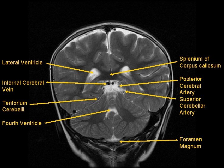 Lateral Ventricle Internal Cerebral Vein Tentorium Cerebelli Splenium of Corpus callosum Posterior Cerebral Artery