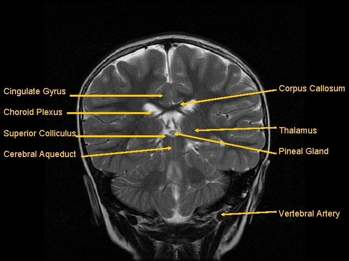 Cingulate Gyrus Corpus Callosum Choroid Plexus Superior Colliculus Thalamus Cerebral Aqueduct Pineal Gland Vertebral