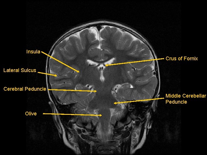Insula Crus of Fornix Lateral Sulcus Cerebral Peduncle Middle Cerebellar Peduncle Olive 
