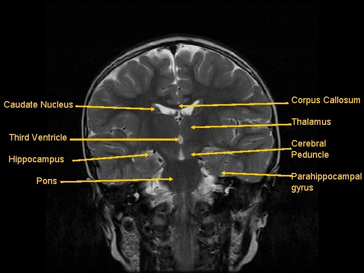 Caudate Nucleus Corpus Callosum Thalamus Third Ventricle Hippocampus Pons Cerebral Peduncle Parahippocampal gyrus 
