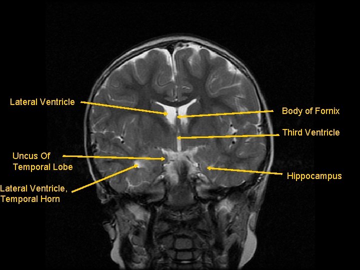Lateral Ventricle Body of Fornix Third Ventricle Uncus Of Temporal Lobe Lateral Ventricle, Temporal