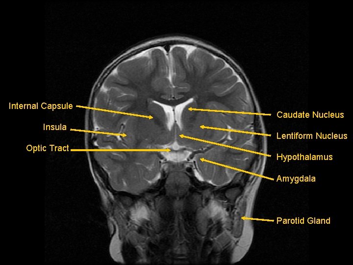 Internal Capsule Insula Optic Tract Caudate Nucleus Lentiform Nucleus Hypothalamus Amygdala Parotid Gland 