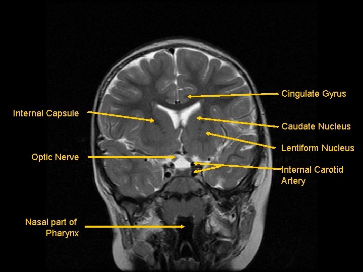 Cingulate Gyrus Internal Capsule Caudate Nucleus Optic Nerve Lentiform Nucleus Internal Carotid Artery Nasal