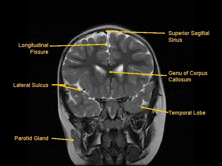 Longitudinal Fissure Lateral Sulcus Superior Sagittal Sinus Genu of Corpus Callosum Temporal Lobe Parotid