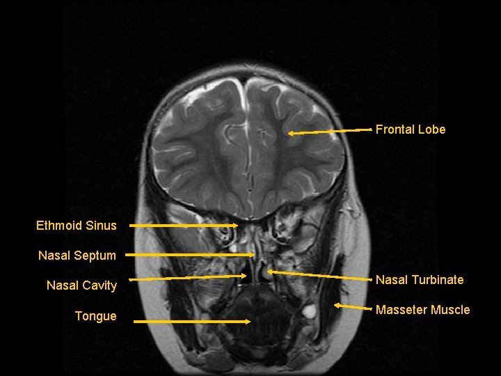 Frontal Lobe Ethmoid Sinus Nasal Septum Nasal Cavity Tongue Nasal Turbinate Masseter Muscle 