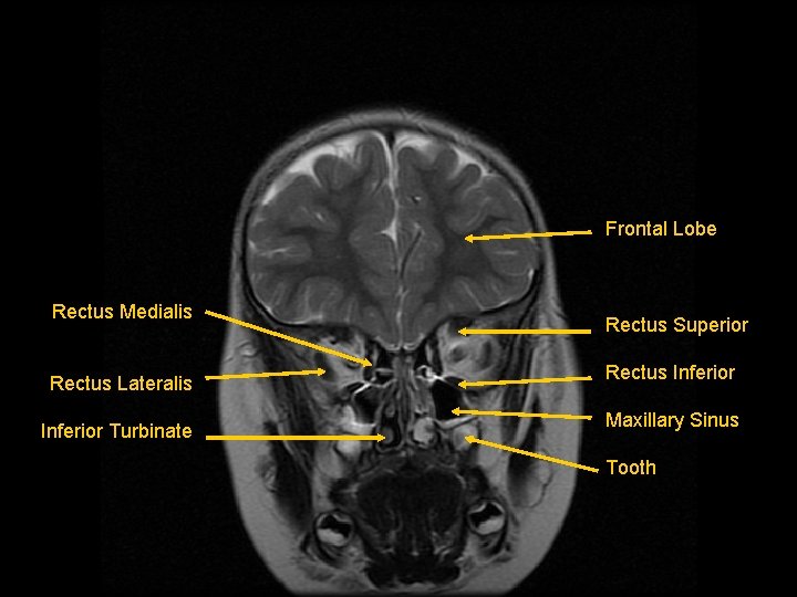 Frontal Lobe Rectus Medialis Rectus Lateralis Inferior Turbinate Rectus Superior Rectus Inferior Maxillary Sinus
