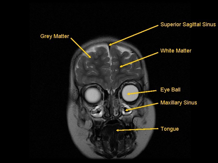 Superior Sagittal Sinus Grey Matter White Matter Eye Ball Maxillary Sinus Tongue 
