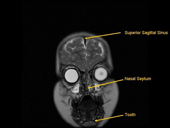 Superior Sagittal Sinus Nasal Septum Tooth 
