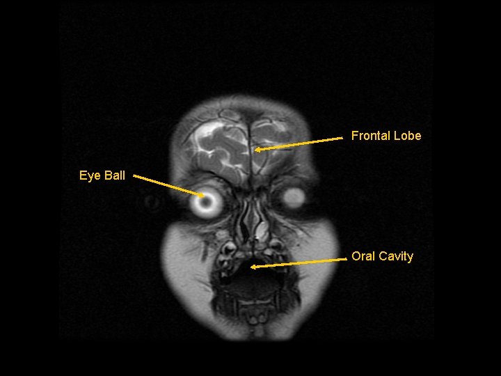 Frontal Lobe Eye Ball Oral Cavity 