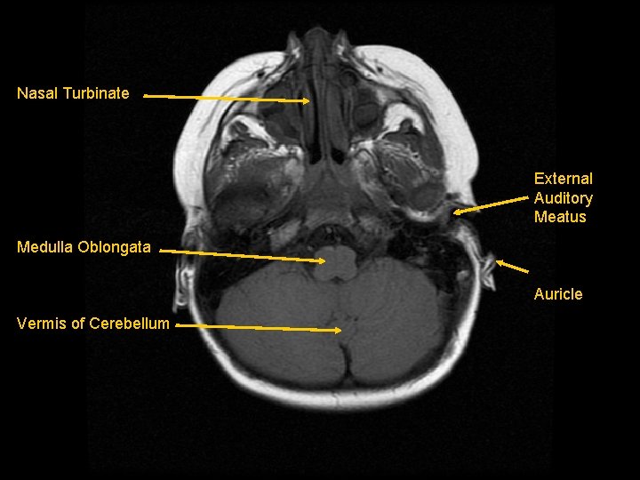 Nasal Turbinate External Auditory Meatus Medulla Oblongata Auricle Vermis of Cerebellum 