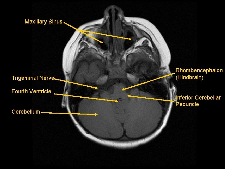Maxillary Sinus Trigeminal Nerve Fourth Ventricle Cerebellum Rhombencephalon (Hindbrain) Inferior Cerebellar Peduncle 