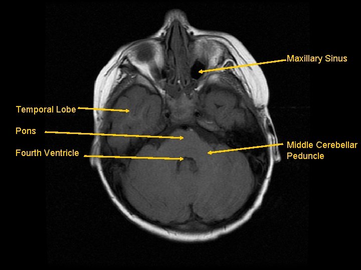 Maxillary Sinus Temporal Lobe Pons Fourth Ventricle Middle Cerebellar Peduncle 