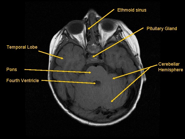 Ethmoid sinus Pituitary Gland Temporal Lobe Pons Fourth Ventricle Cerebellar Hemisphere 