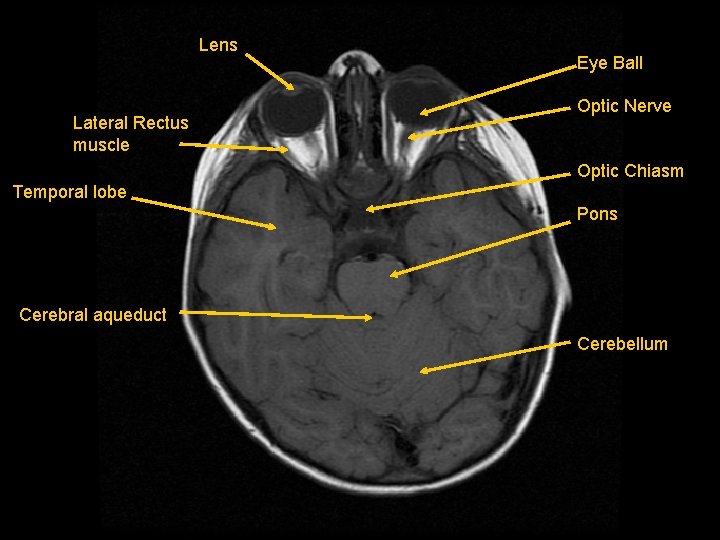 Lens Lateral Rectus muscle Eye Ball Optic Nerve Optic Chiasm Temporal lobe Pons Cerebral