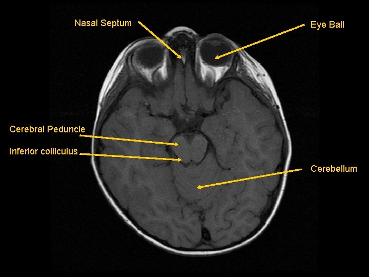Nasal Septum Eye Ball Cerebral Peduncle Inferior colliculus Cerebellum 