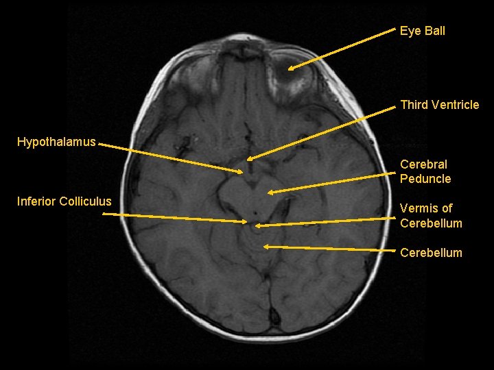 Eye Ball Third Ventricle Hypothalamus Cerebral Peduncle Inferior Colliculus Vermis of Cerebellum 