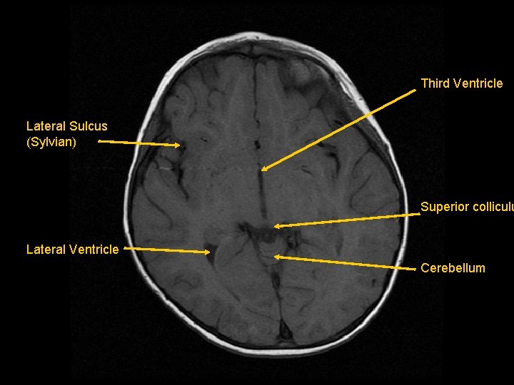 Third Ventricle Lateral Sulcus (Sylvian) Superior colliculu Lateral Ventricle Cerebellum 