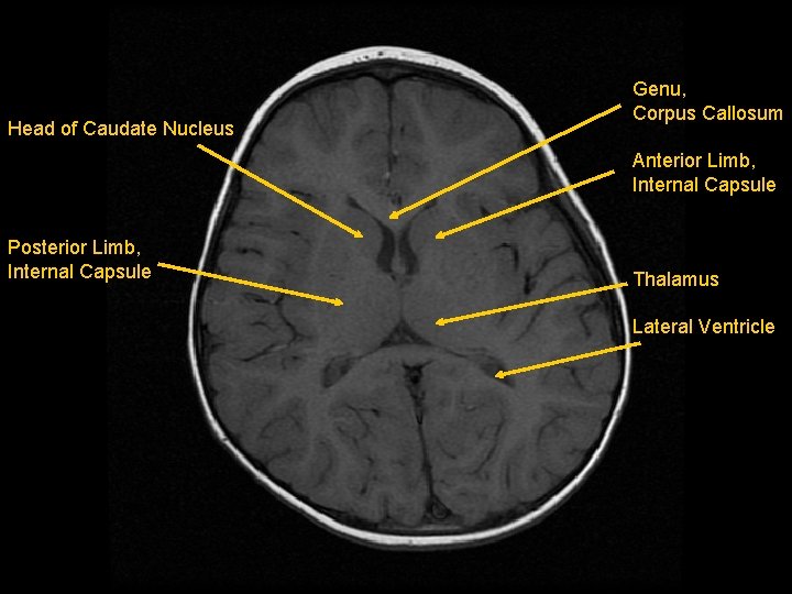 Head of Caudate Nucleus Genu, Corpus Callosum Anterior Limb, Internal Capsule Posterior Limb, Internal