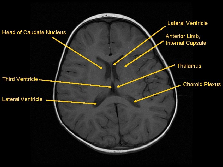 Lateral Ventricle Head of Caudate Nucleus Anterior Limb, Internal Capsule Thalamus Third Ventricle Lateral