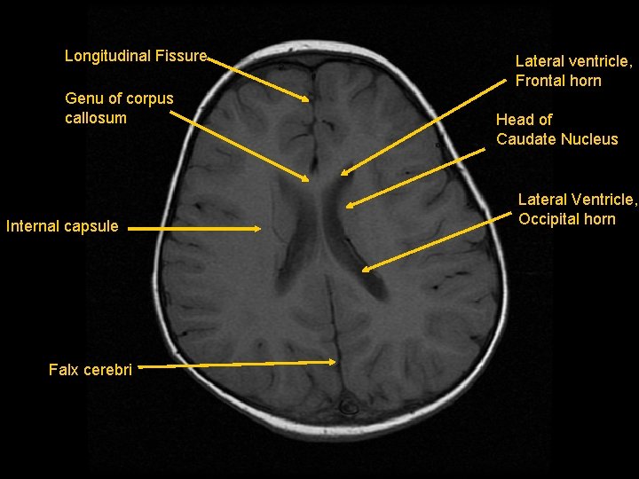 Longitudinal Fissure Genu of corpus callosum Internal capsule Falx cerebri Lateral ventricle, Frontal horn