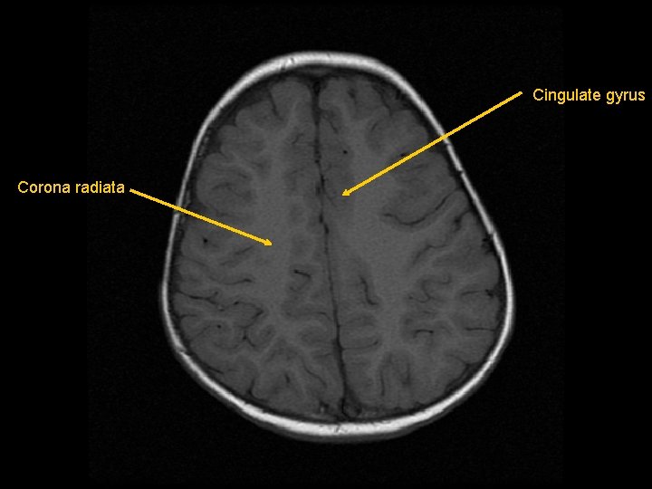 Cingulate gyrus Corona radiata 