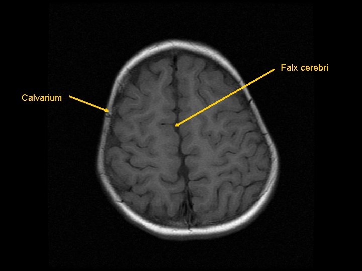 Falx cerebri Calvarium 