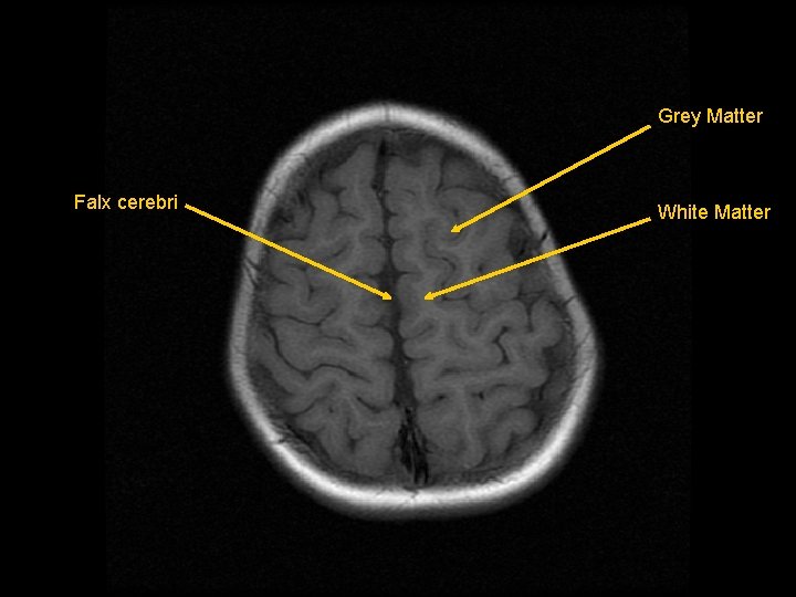 Grey Matter Falx cerebri White Matter 