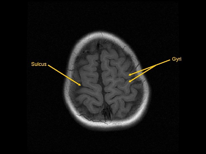 Sulcus Gyri 