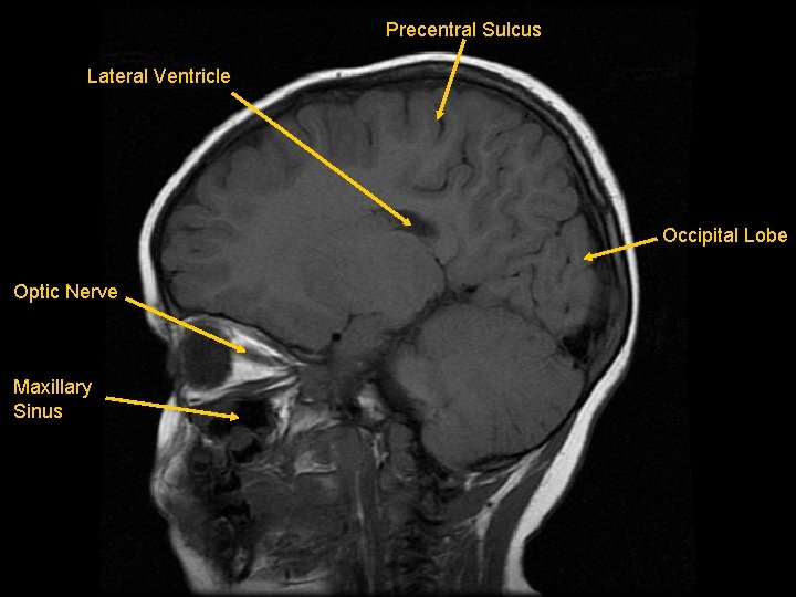 Precentral Sulcus Lateral Ventricle Occipital Lobe Optic Nerve Maxillary Sinus 