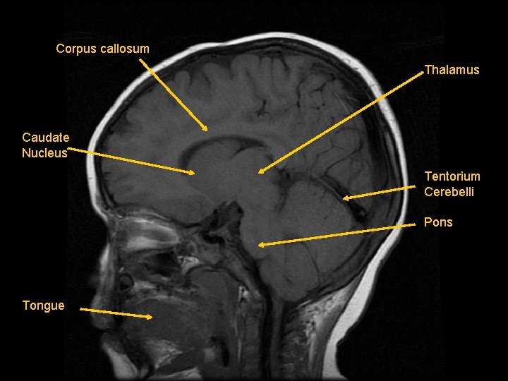 Corpus callosum Thalamus Caudate Nucleus Tentorium Cerebelli Pons Tongue 