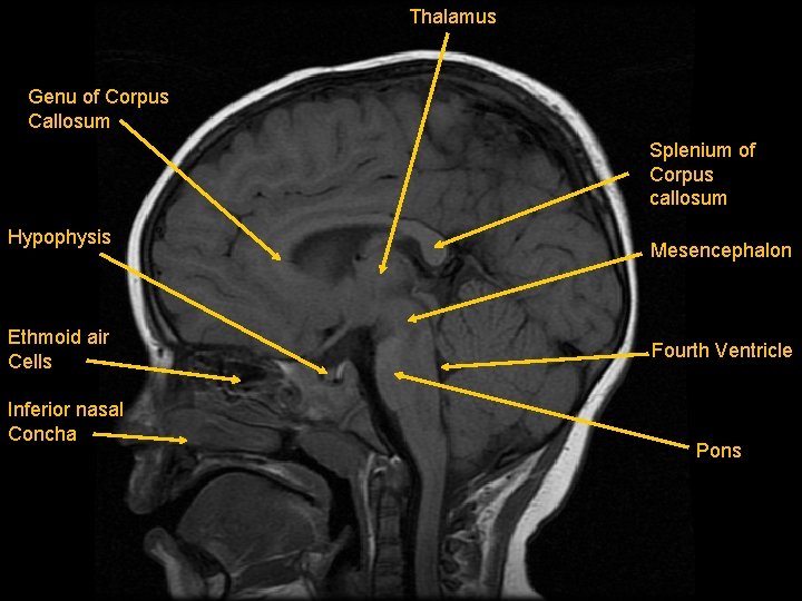 Thalamus Genu of Corpus Callosum Splenium of Corpus callosum Hypophysis Ethmoid air Cells Inferior