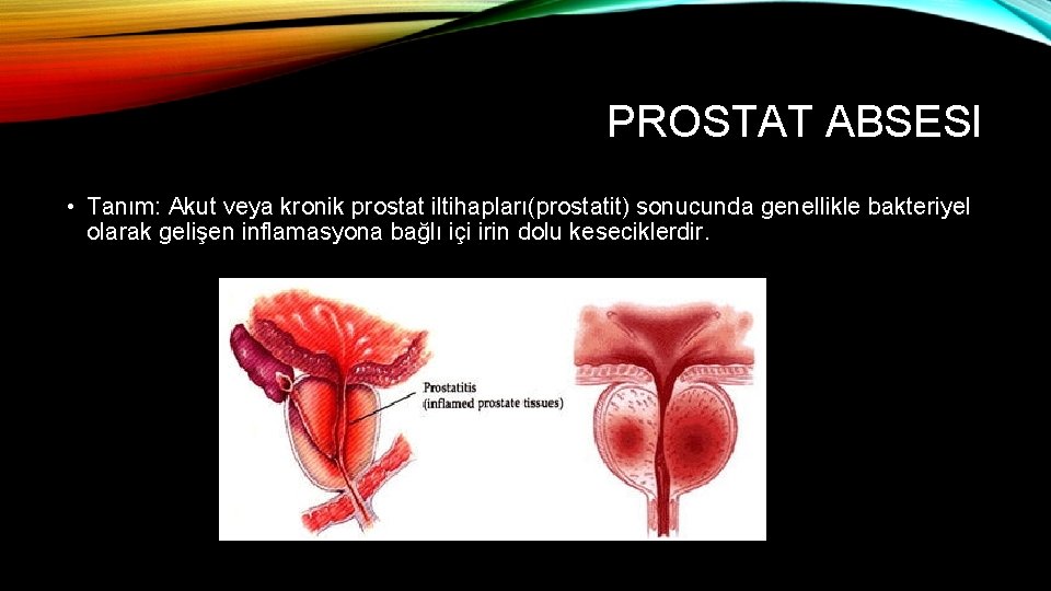 PROSTAT ABSESI • Tanım: Akut veya kronik prostat iltihapları(prostatit) sonucunda genellikle bakteriyel olarak gelişen