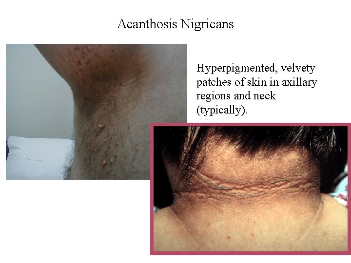 Acanthosis Nigricans Hyperpigmented, velvety patches of skin in axillary regions and neck (typically). 