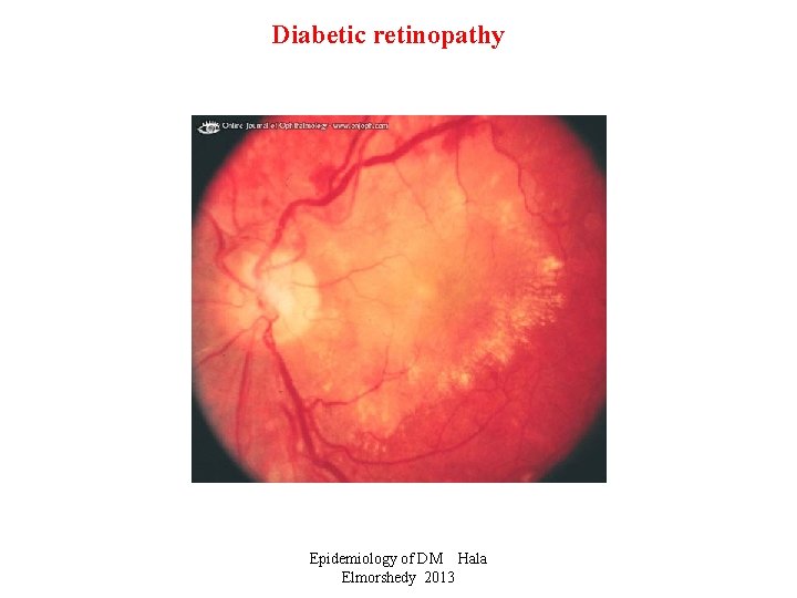 Diabetic retinopathy Epidemiology of DM Hala Elmorshedy 2013 