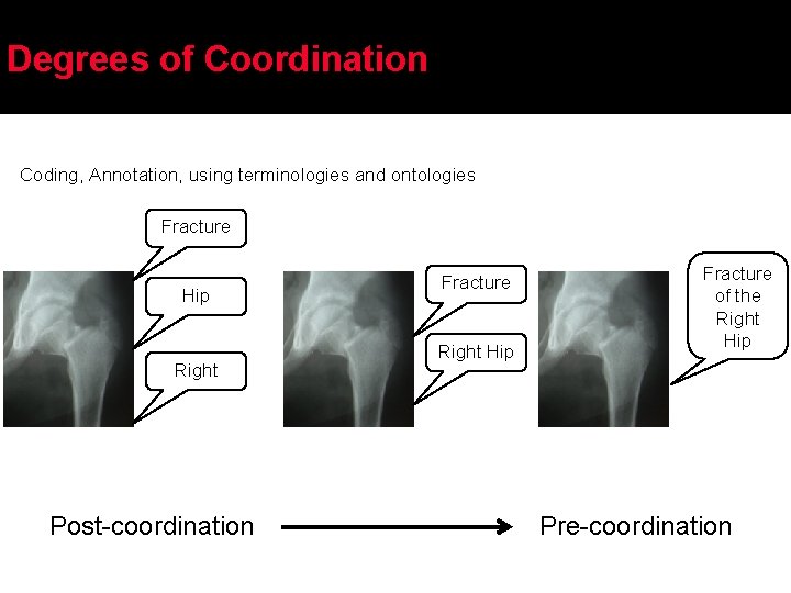 Degrees of Coordination Coding, Annotation, using terminologies and ontologies Fracture Hip Right Post-coordination Fracture