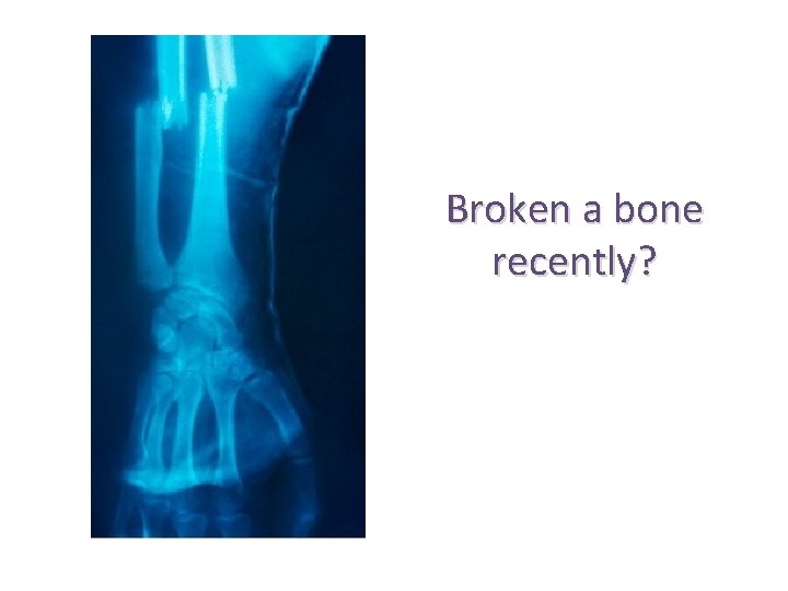 Broken a bone recently? 