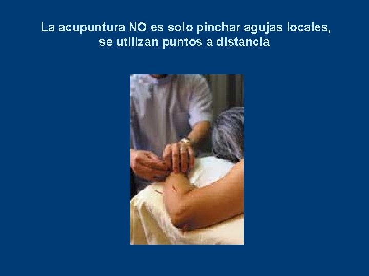 La acupuntura NO es solo pinchar agujas locales, se utilizan puntos a distancia 
