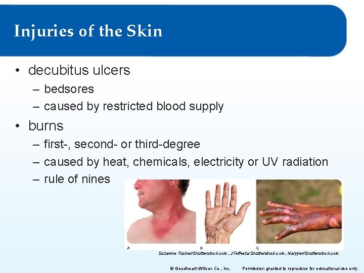 Injuries of the Skin • decubitus ulcers – bedsores – caused by restricted blood