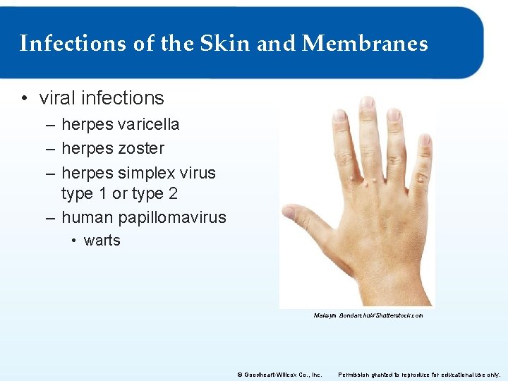 Infections of the Skin and Membranes • viral infections – herpes varicella – herpes