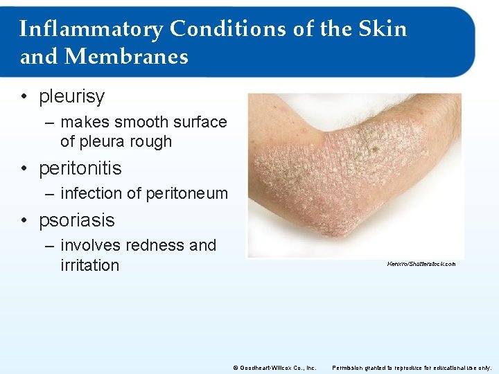 Inflammatory Conditions of the Skin and Membranes • pleurisy – makes smooth surface of