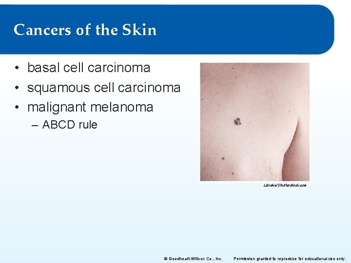 Cancers of the Skin • basal cell carcinoma • squamous cell carcinoma • malignant