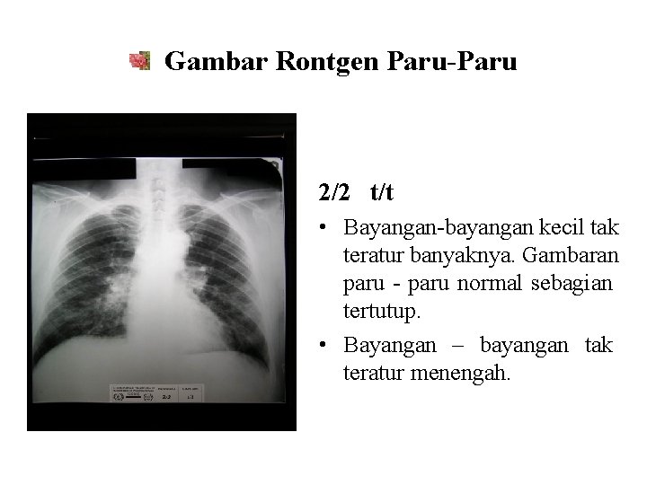 Gambar Rontgen Paru-Paru 2/2 t/t • Bayangan-bayangan kecil tak teratur banyaknya. Gambaran paru -