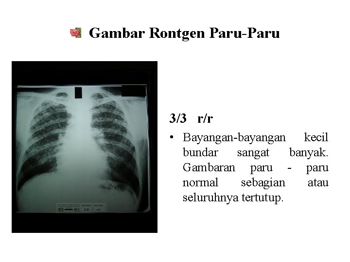 Gambar Rontgen Paru-Paru 3/3 r/r • Bayangan-bayangan kecil bundar sangat banyak. Gambaran paru -