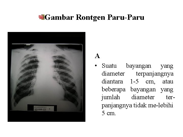 Gambar Rontgen Paru-Paru A • Suatu bayangan yang diameter terpanjangnya diantara 1 -5 cm,